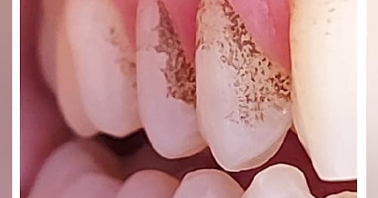 Management Of Tartar And Tooth Stains: A Challenge For Dental