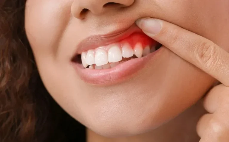 Innovative Topical Gel Treats And Prevents Gum Disease At Home