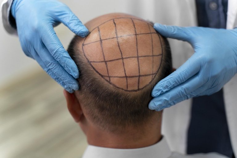 Top 10 Hair Transplant Clinics In Turkey 2025