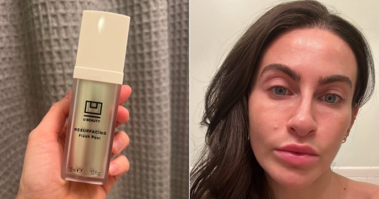 U Beauty Resurfacing Flash Peel Review With Photos