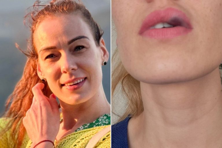 Woman Says Lip Filler Swelling Led To Rare Cancer Diagnosis