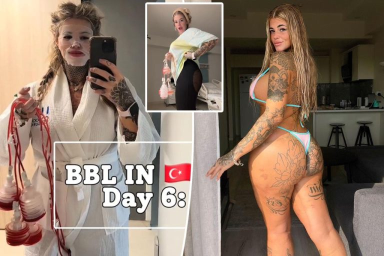 Women With 13 Plastic Surgeries Take The Second Bbl After