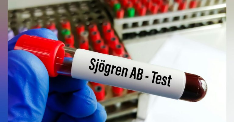 Innovative oral health approach to sjögren's syndrome: new study for