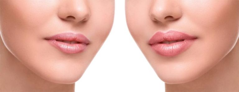 Trends of the lips growth market in cosmetics and aesthetics