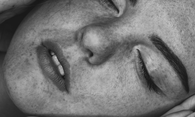 Best laser treatments after skin tightening Best laser treatments after skin tightening