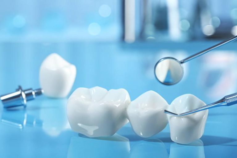 Dental purchase process and bridges explained 2024-2031 Dental purchase process and bridges explained 2024 2031