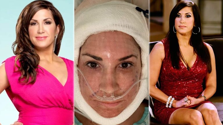 Rhonj alum jacqueline laurita reveals facelift and neck lifting surgery
