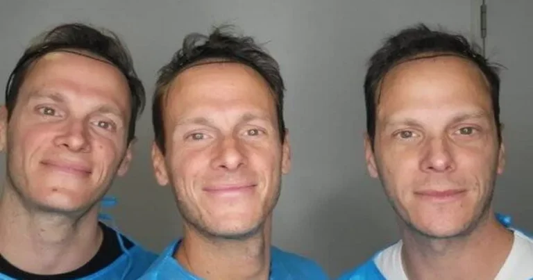 The triads celeb have first 5k hair transplants in the
