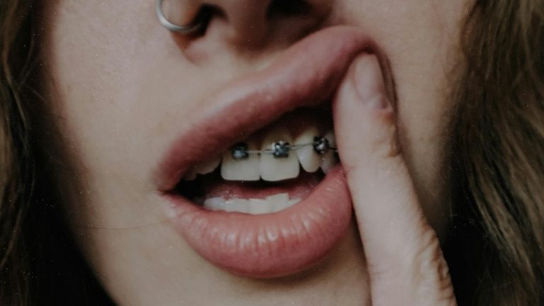 #Bodytalkwithcosmo: braces at 30? Here is everything you need to know before you commit #bodytalkwithcosmo: braces at 30? here is everything you need to