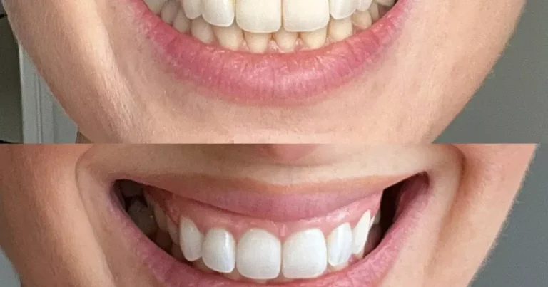 Buyers who "didn't want to smile" take much whiter teeth