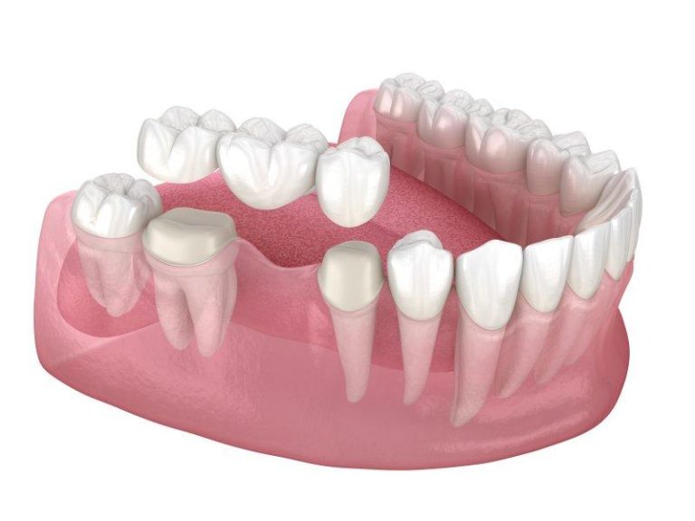 Dental crown and market bridges for tooth restoration