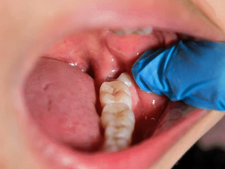 National Dentist Day- Assistant tooth of Wisdom National dentist day assistant tooth of wisdom