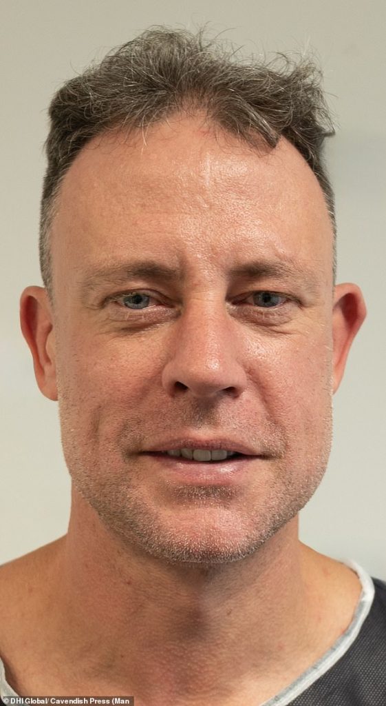The wayne bridge shows the results of the hair transplant