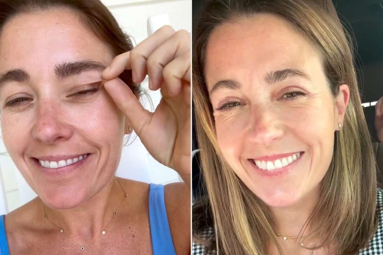 The woman takes surgery superior bleph for her loose eyelids.