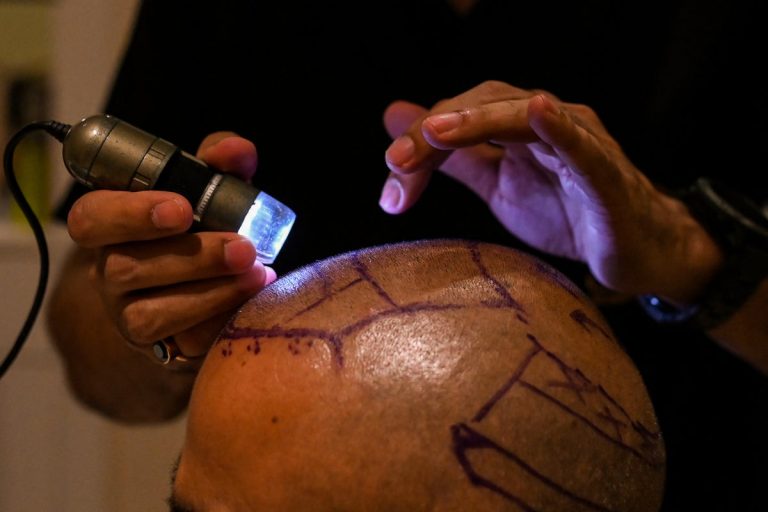 Two dead after hair transplant surgery go terribly wrong