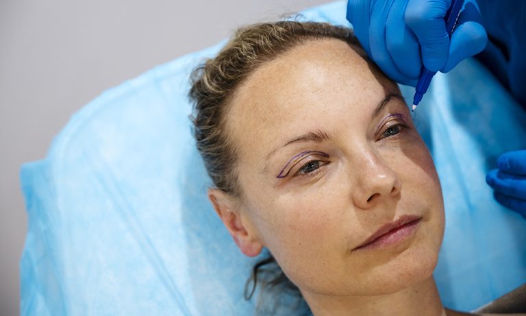 Blepharoplasty before and after: 7 transformations that open eyes Blepharoplasty before and after: 7 transformations that open eyes