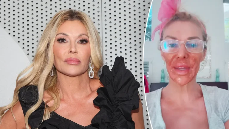 Brandi glanville burns the face with nair to treat face