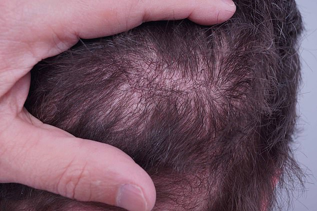 Hair Transplant Experts issue a warning of UK clinics that let men deform and depressed: “Worse than Turkey” Hair transplant experts issue a warning of uk clinics that