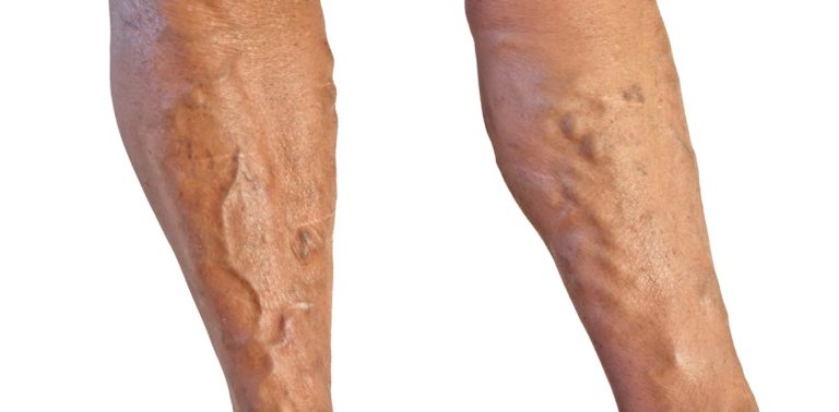 I have varicose veins. what can i do for them?