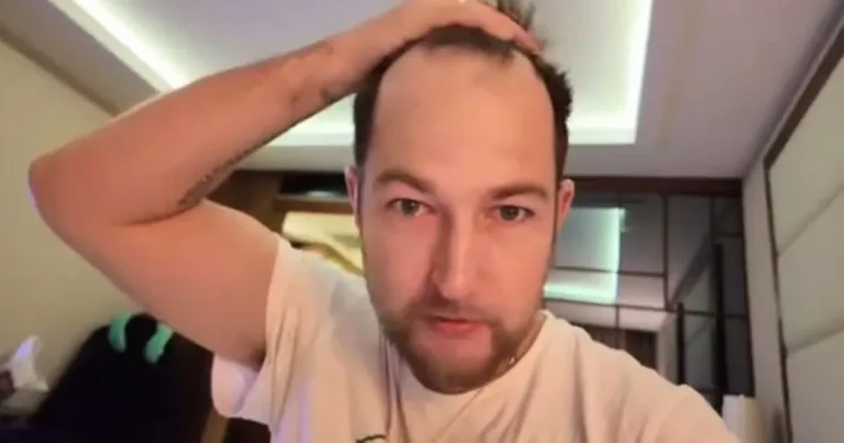 Man, 35 years old, takes £ 1,370 hair transplant to avoid looking like a family member Man, 35 years old, takes £ 1,370 hair transplant to