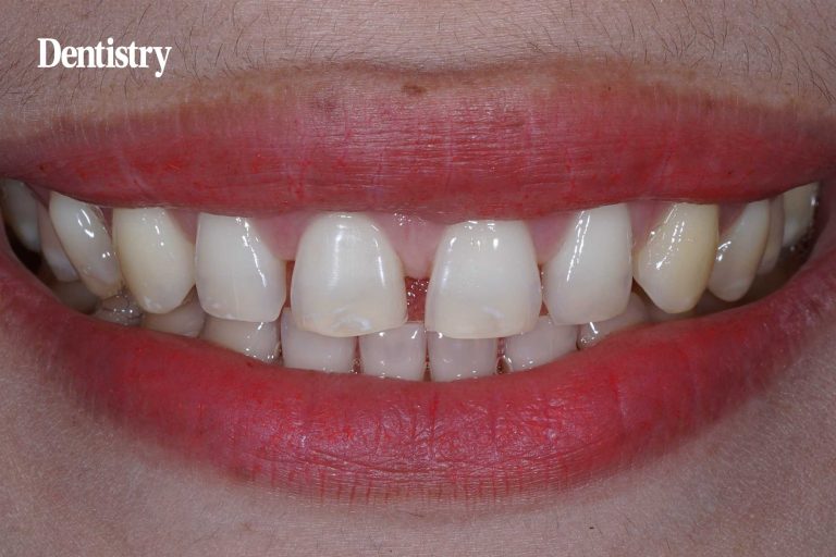 Treatment of upper anterior distance with invisalign