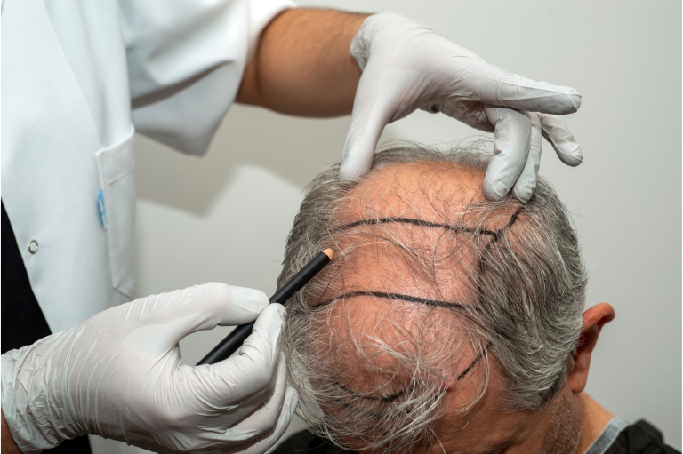 Trust your scalp with the best: Hair Transplant Clinics Top 7 of 2025 Trust your scalp with the best: hair transplant clinics top