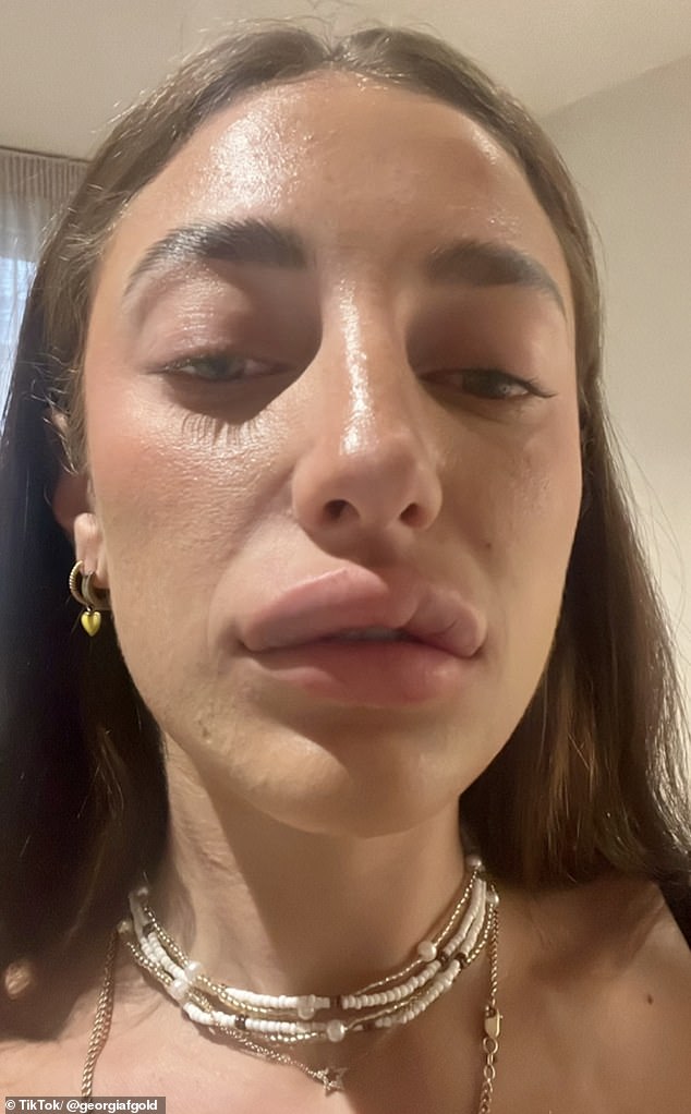Woman reveals what really happens when you get the full lips dissolve Woman reveals what really happens when you get the full