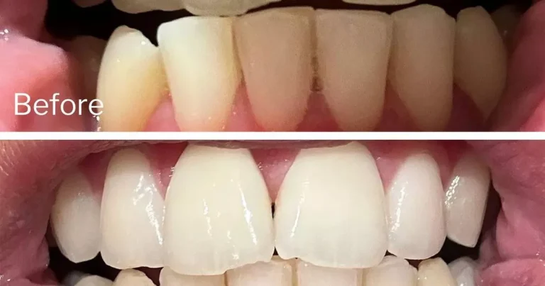 Buyers praised 95p teeth whitening strips, as the smile is