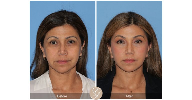 Dr. kevin sadati leads the category with facelift preservation