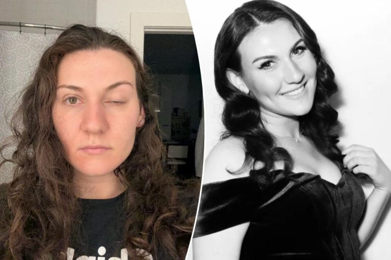 I can't open my eye after really bad bottox botox