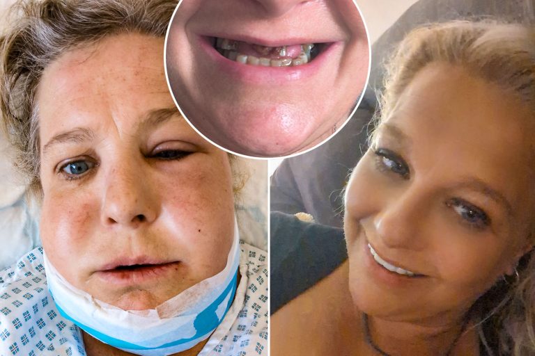 Mom's urgent warning, after veneer