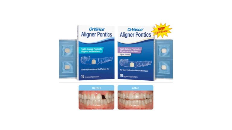 Orvance aligner pontics adds light shade, restraint use