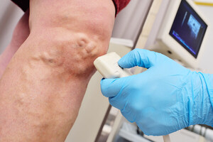 Radiofrequency and laser procedures are equally effective for vein varicose veins Radiofrequency and laser procedures are equally effective for vein varicose