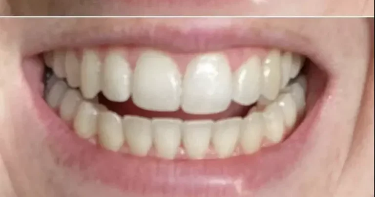 Teeth whitening solutions backed by a dentist say 'works from