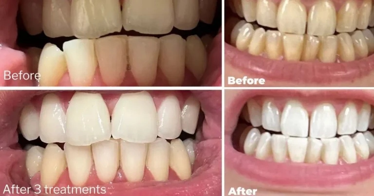 Teeth whitening tooth backed with a dentist continue to say they will “buy again” Teeth whitening tooth backed with a dentist continue to say