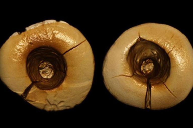 The 13,000 year old fills prove that ancient dentistry was