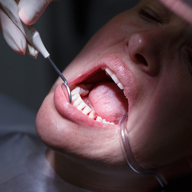 Will gum disease enhance the risk of dementia?