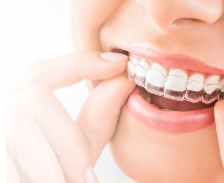 Bradford wibsey invisalign clear aligners consults announced in taylored dental