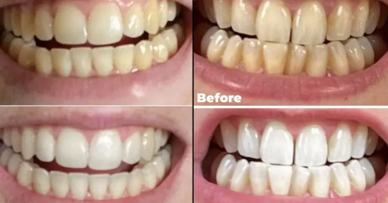 Buyers say these 95p whitening strips make teeth look brighter