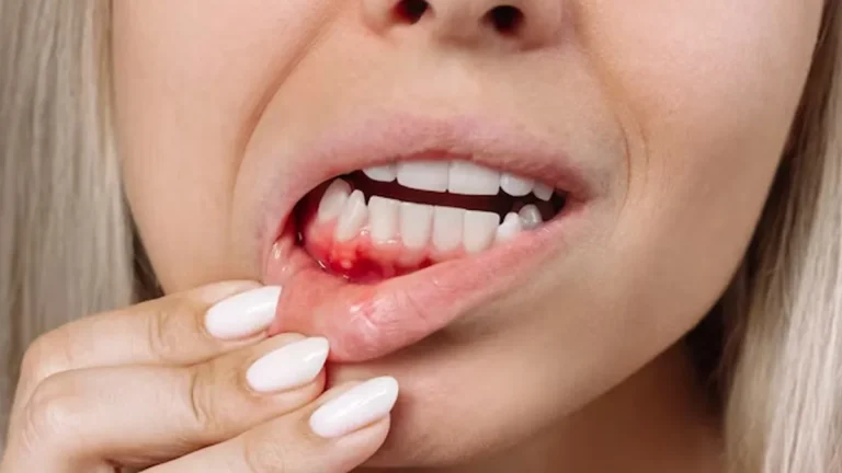 Can gum disease be cured? Explains the expert Can gum disease be cured? explains the expert