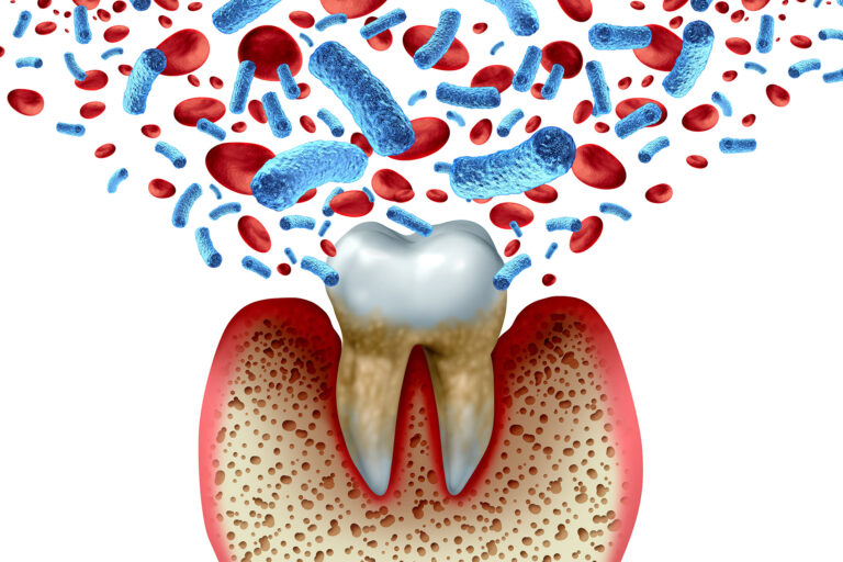 Gum disease, the diabetes connection — harvard gazette