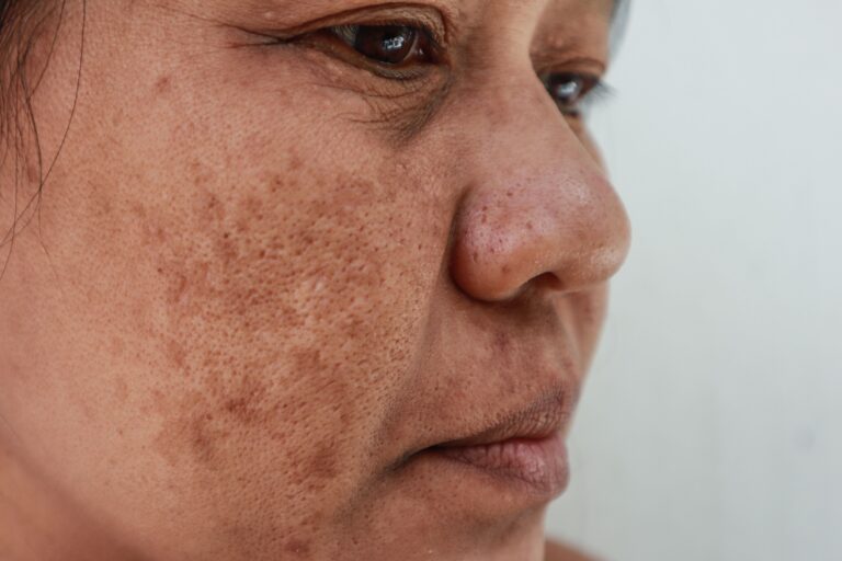 How medium to deep chemical peels treat refractory melasma