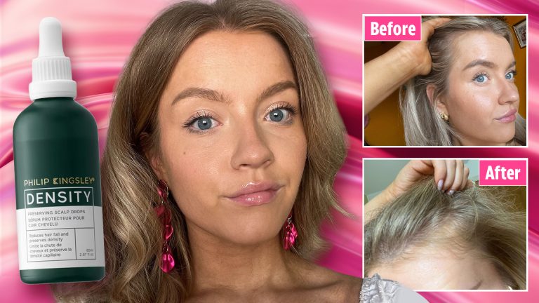 I felt pressured to head to turkey for hair transplantation