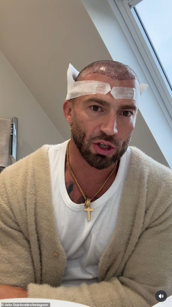 Jake ququenden undergoes his third hair transplantation, since he sincerely