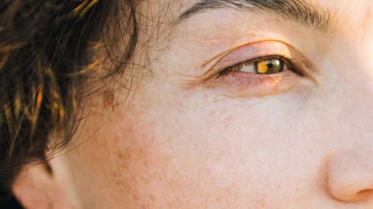 Phenol peels are dermatology's scariest chemical peel — but are