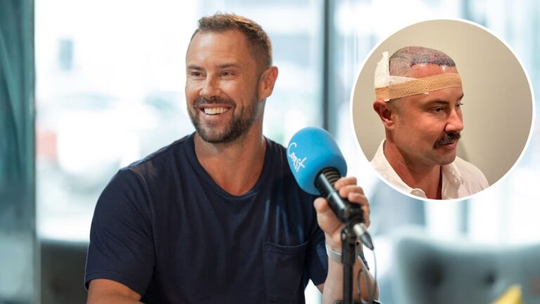 Radio's sam wallace opens up about his hair transplant journey
