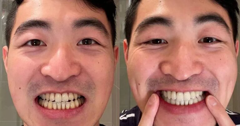 The best Prime Day teeth whitening deal saves £120 but it’s not on Amazon The best prime day teeth whitening deal saves £120 but