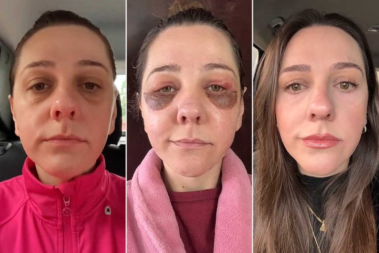 The woman shares bleph surgery in viral tiktoks. see her