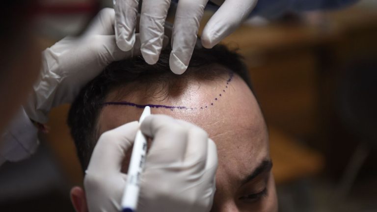 What makes this country a top destination for hair transplants: NPR What makes this country a top destination for hair transplants: