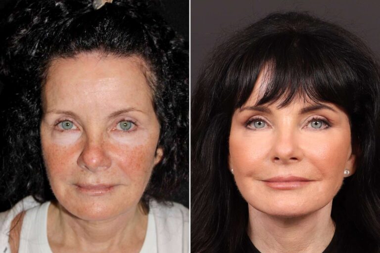 Woman, 65, gets plastic surgery to treat 'turkey neck' —